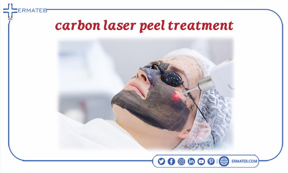 carbon laser peel treatment